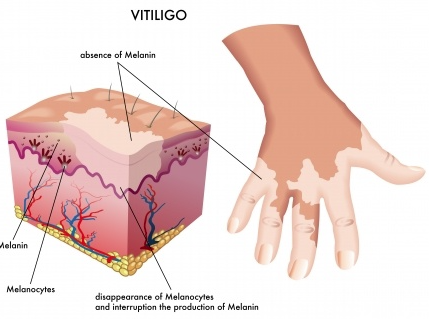 vitiligo 