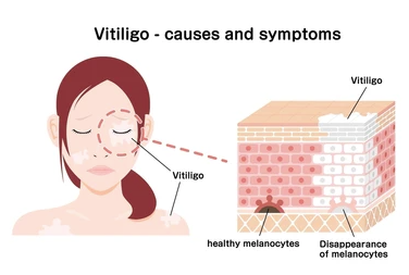 Is Vitiligo Related With Autoimmune Function